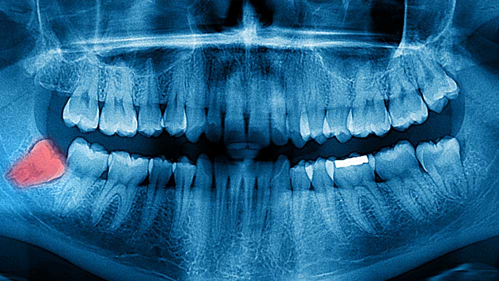 Fun Facts About Wisdom Teeth